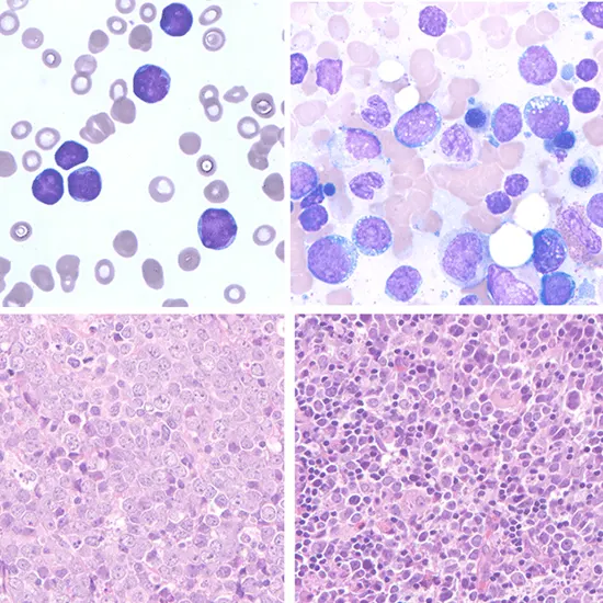 (Double and Triple) Hit Lymphoma Blood and BM
